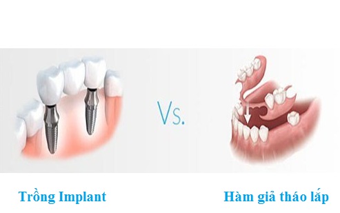 Ai là người đầu tiên chế ra răng giả. Bách Khoa Tri Thức