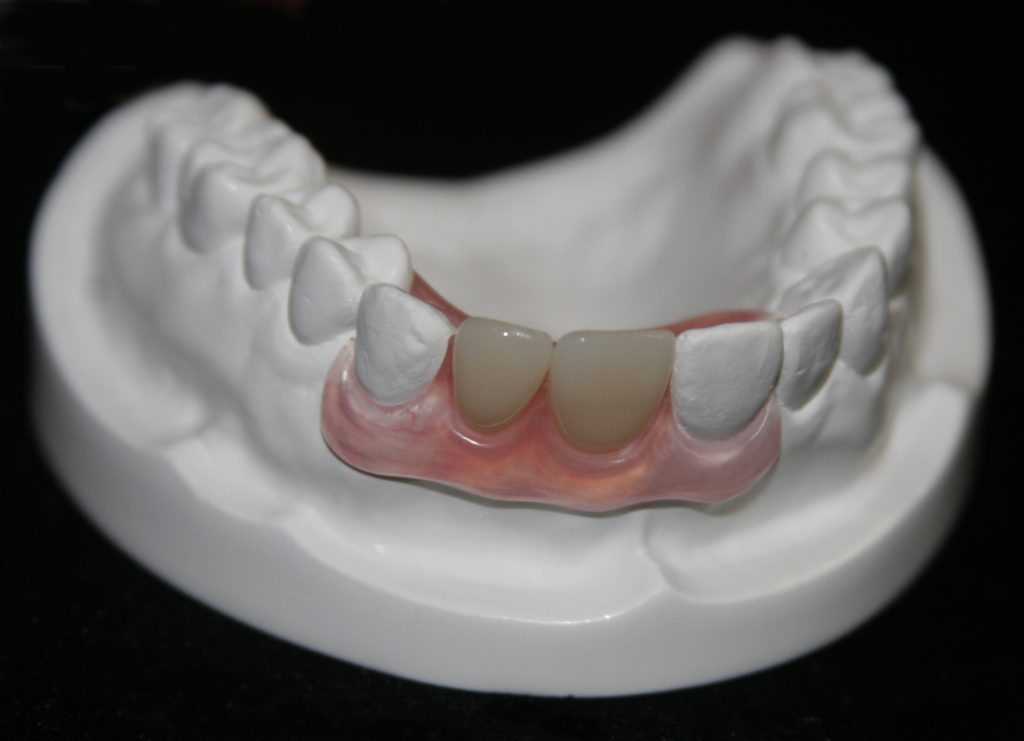 Bạn biết gì về sự cải tiến của hàm răng giả. Bách Khoa Tri Thức