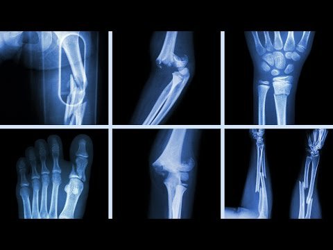 Bằng cách nào xương bị gãy, dập lại lành lặn được. Bách Khoa Tri Thức