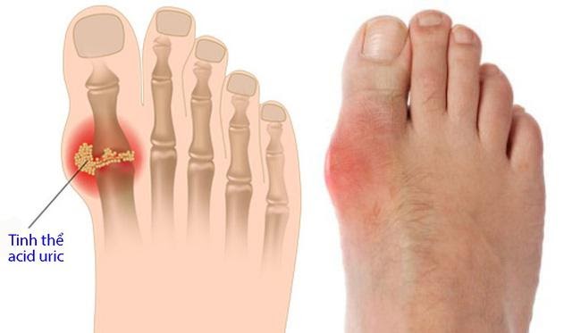 Bệnh “gút” là gì. Bách Khoa Tri Thức