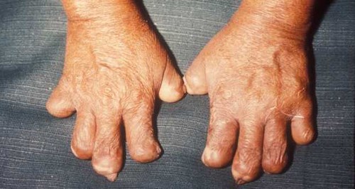 Bệnh phong có lây không. Bách Khoa Tri Thức