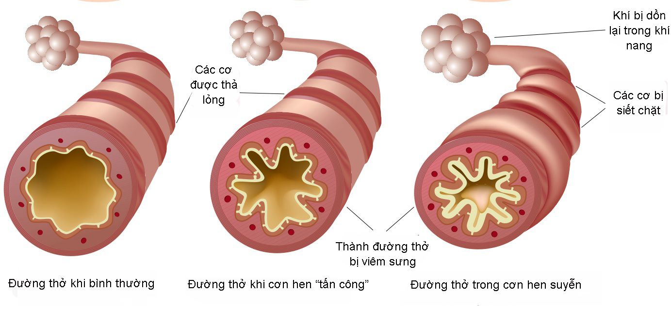 Bệnh suyễn là bệnh gì. Bách Khoa Tri Thức