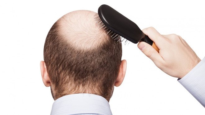 Cái gì đã gây ra chứng sói đầu. Bách Khoa Tri Thức