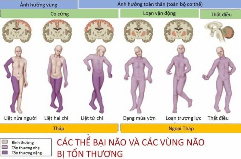 Chứng bại não là gì. Bách Khoa Tri Thức