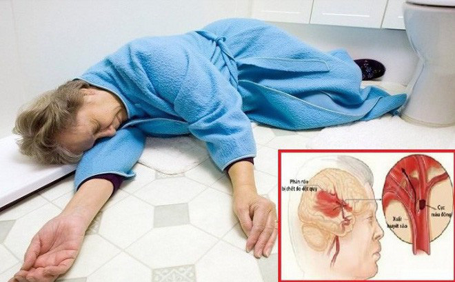 Chứng đột quỵ là gì. Bách Khoa Tri Thức