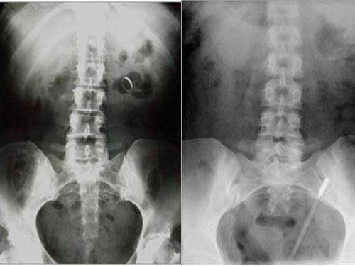 Dị vật kỳ lạ trong cơ thể người. Bách Khoa Tri Thức
