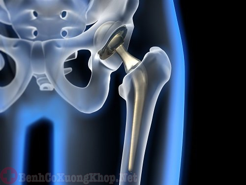 Điện thoại di động có thể khiến cho các khớp nối nhân tạo bị đau không. Bách Khoa Tri Thức
