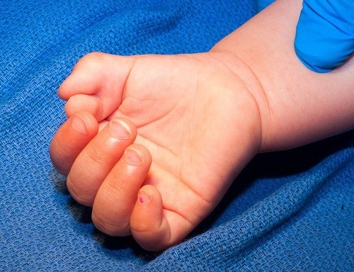 Tại sao có người có nhiều ngón tay hoặc nhiều ngón chân. Bách Khoa Tri Thức