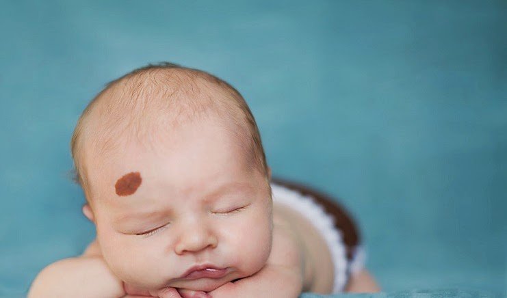 Tại sao có người lại có vết bớt. Bách Khoa Tri Thức