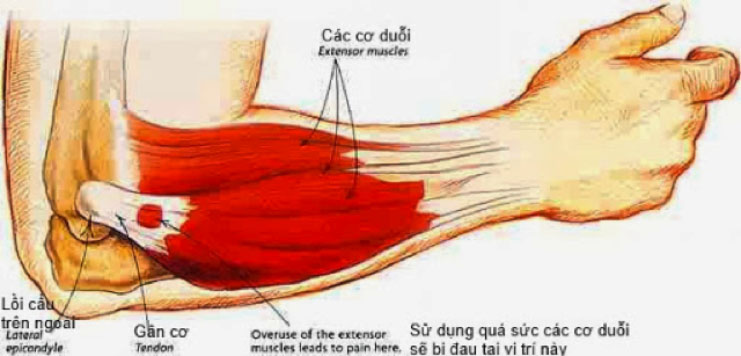 Tại sao sau khi vận động, bắp cơ của ta bị nhức mỏi. Bách Khoa Tri Thức