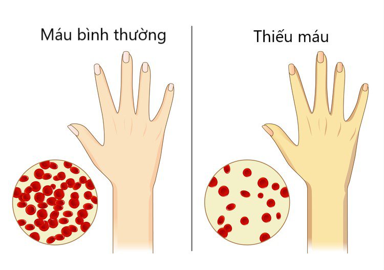 Tại sao ta bị chứng thiếu máu. Bách Khoa Tri Thức