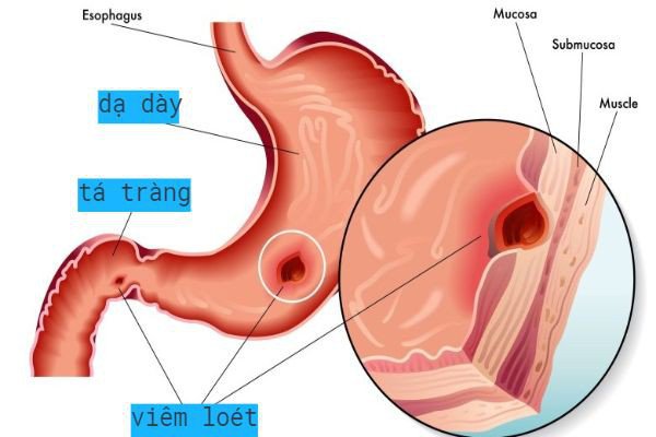 Tại sao ta bị loét bao tử. Bách Khoa Tri Thức