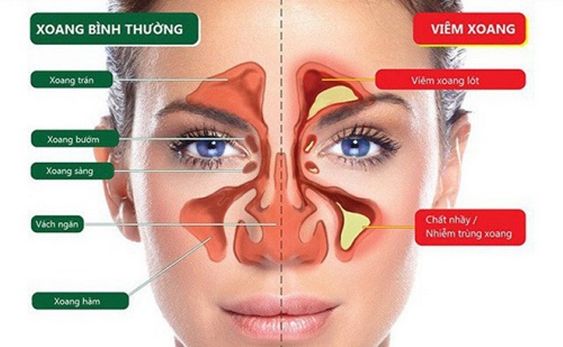Tại sao ta bị nghẹt mũi. Bách Khoa Tri Thức