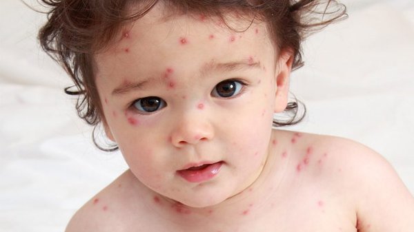 Tại sao trẻ em bị thủy đậu. Bách Khoa Tri Thức